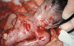 Abortgränsen diskuterad – vårdpersonal vill se en sänkning