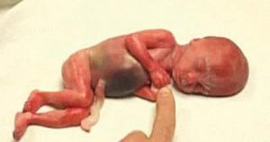 Ny abortstorm i Aftonbladet